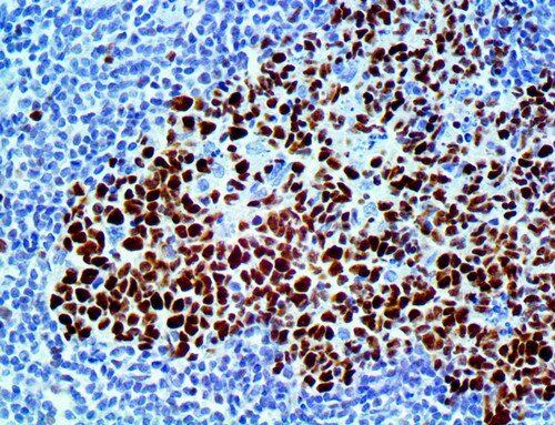 IHC of bcl-6 on a FFPE Colon Tissue